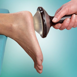 Plantar Fasciitis Shockwave Therapy Treatment